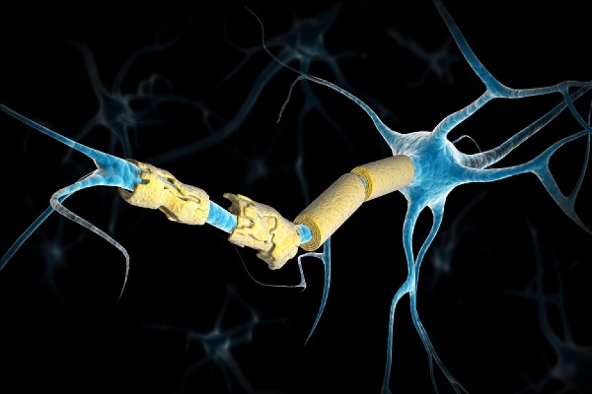 Chronic inflammatory demyelinating polyneuropathy