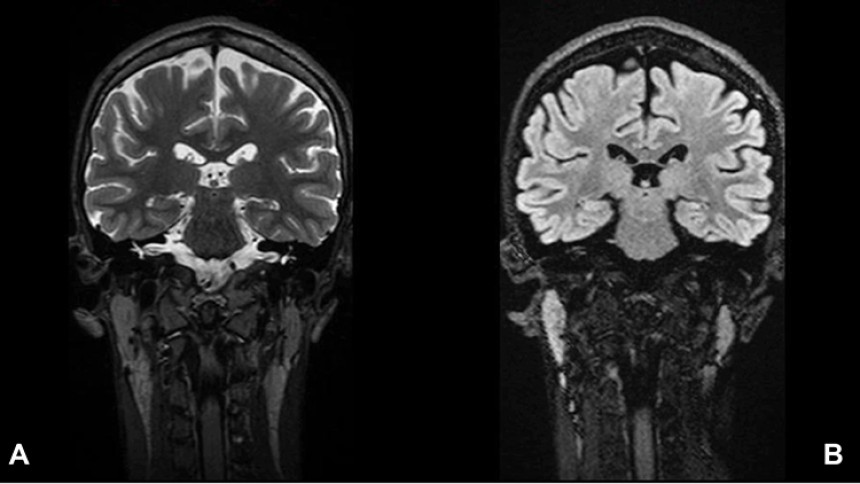 Miller Fisher syndrome