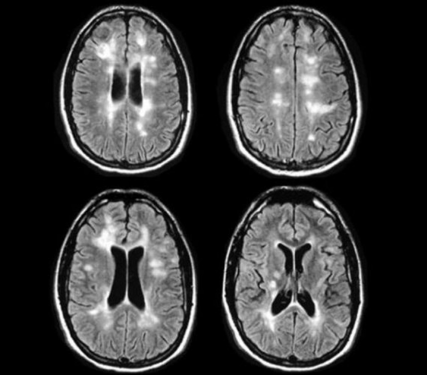 Multiple sclerosis RRMS Latest Diagnostic criteria