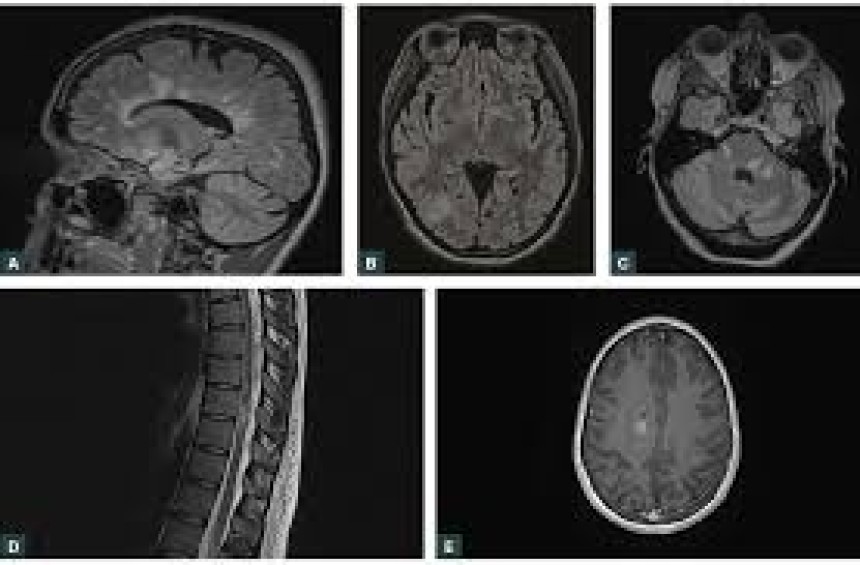 Multiple sclerosis RRMS Choice of Initial Disease modifying Drugs